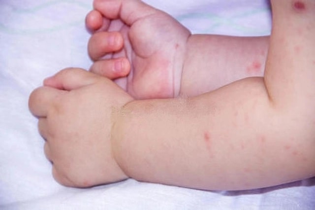 A baby's arms showing multiple mosquito bites, with small red bumps typical of a reaction to mosquito bites