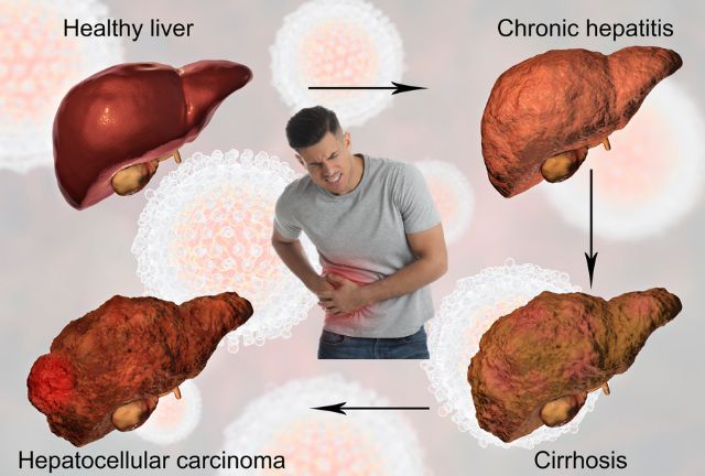 The 6 Major Symptoms of Liver Cancer